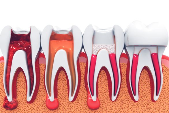 Advanced Root Canal Therapy in vadodara